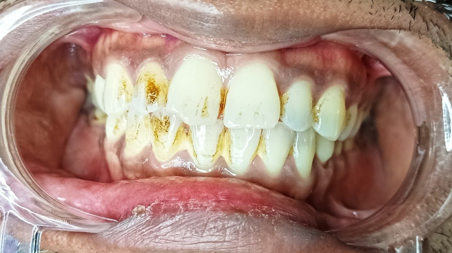 Before Surgery